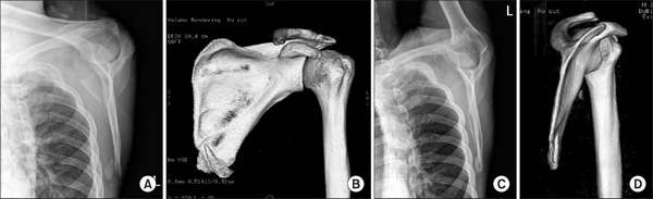Рентген - основной способ диагностики перелома лопатки